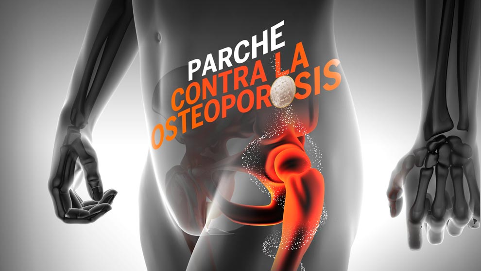 Alumna de la UNAM crea parche para tratar la osteoporosis